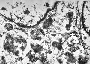 M, 38y. | granular cell tumor